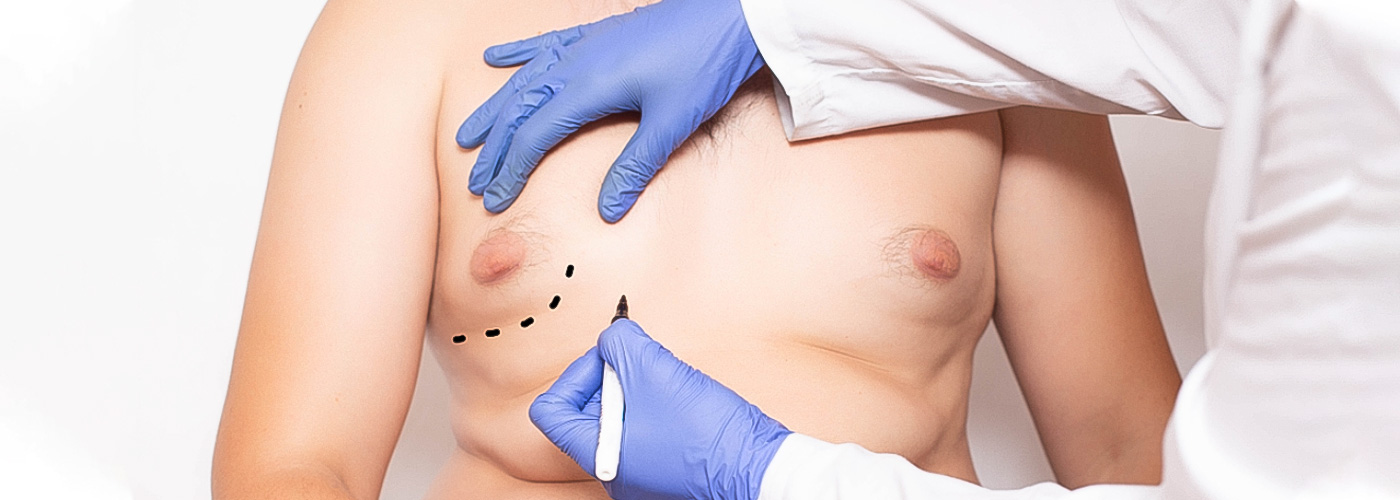 روش‌های جراحی سینه برای عارضه ژنیکوماستی