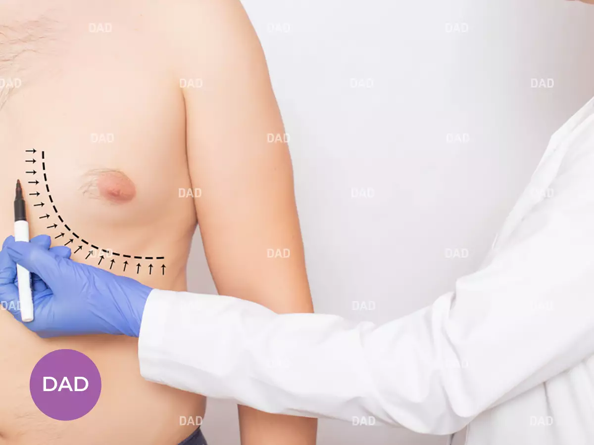 ژنیکوماستی در بدنسازان