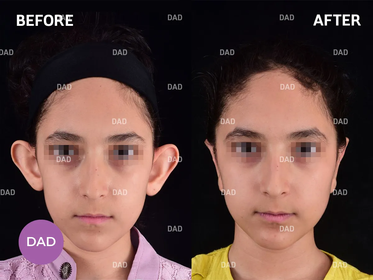 جراحی گوش برجسته کودکان