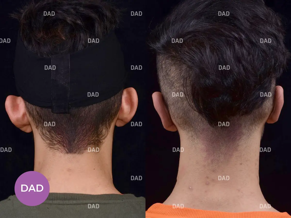 جراحی گوش برجسته کودکان